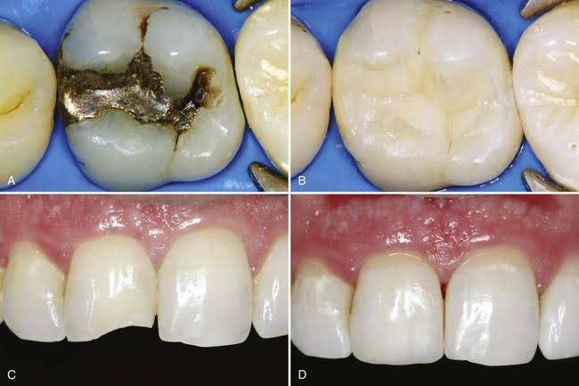 Dental filling and restoration procedure