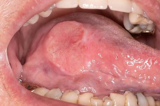Consultation for oral oncology
