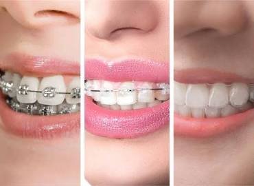 Orthodontic braces and aligner treatment