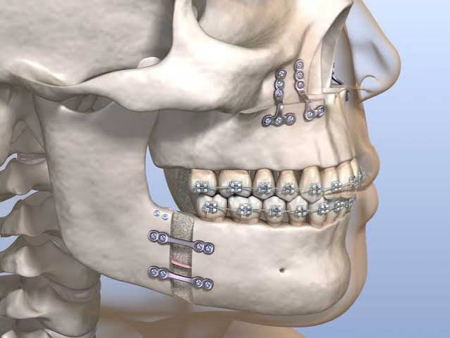 Orthognathic jaw surgery consultation