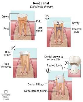Root canal treatment procedure