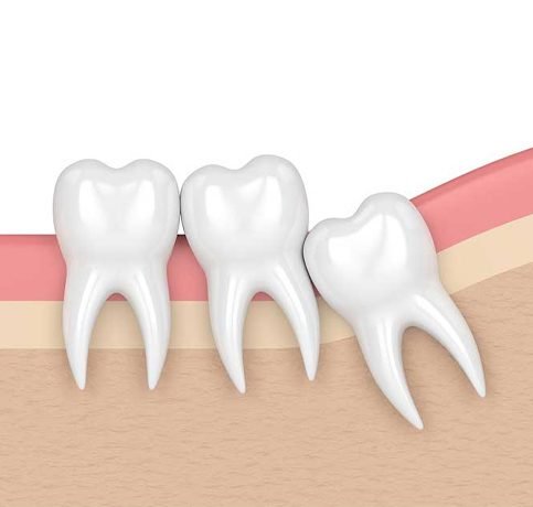 Third molar impaction surgery at Dr. Akanksha's dental chamber